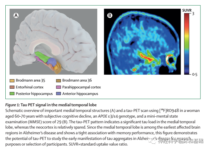 Lancet Neurol—Tau蛋白生物标志物研究的现状及<font color="red">未来</font>