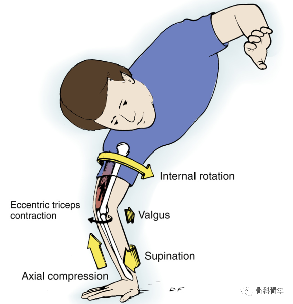 急性肘关节脱位的6种手法复位方法