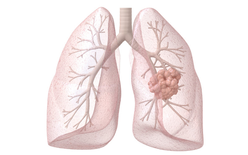 肺癌患者用药PD-1和PD-L1怎么选？一文详解