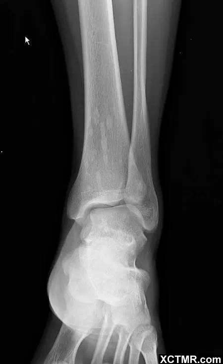 骨<font color="red">斑点</font>症(Osteopoikilosis)X线病例图片影像诊断分析