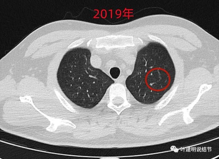 问诊分析（2022.12.22）：肺结节太常见，这种样子的结节影像不报又何妨？