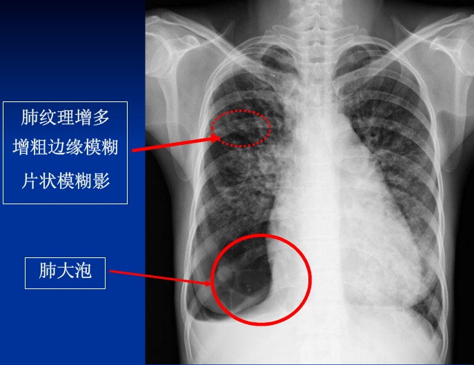 不同类型肺水肿的CT表现