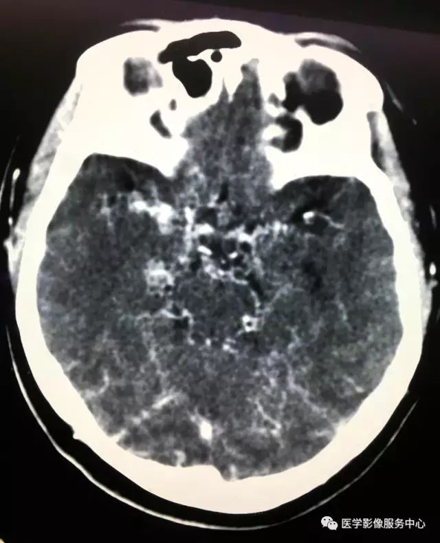 Moyamoya病，仅凭一层CT图像即可确诊的疾病
