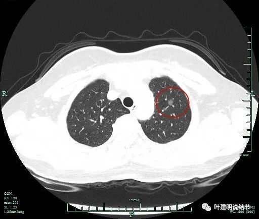 病例分享（2023.2.22）：这肺结节位置挺尴尬，到底该怎么切最优？