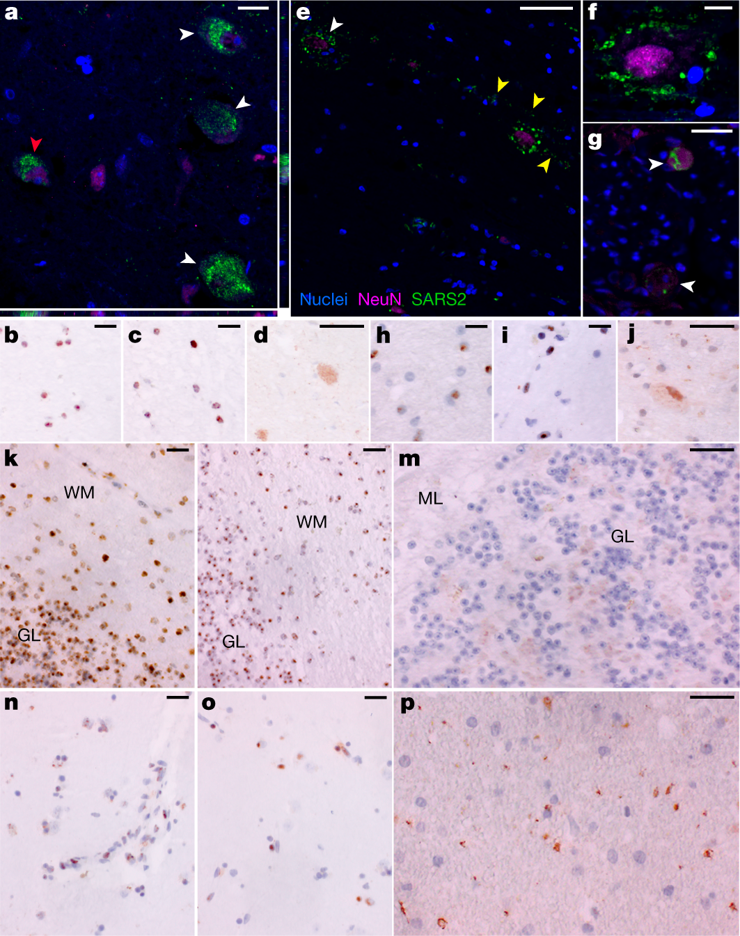 Nature最全面分析：对11名患者中枢神经系统采样，在<font color="red">大脑</font>发现SARS-CoV-2持续存在