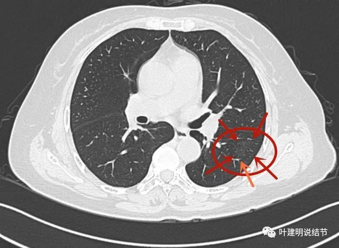 罕见病例：肺部这种巨大病灶<font color="red">PET-CT</font>、增强<font color="red">CT</font>都没用，但必定是这种病！