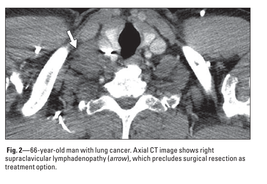 胸部CT盲点—肺外结构