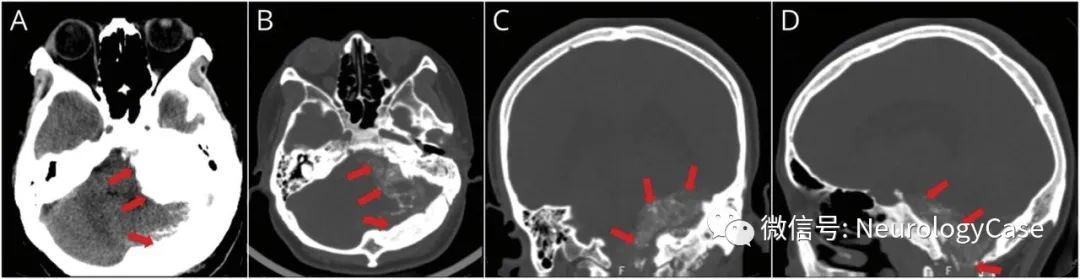 Neurology病例：继发于后颅窝扁平肥厚性脑膜瘤的脊髓空洞症