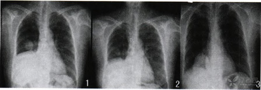 每日一例：中华胸心血管外科杂志：肺原发性平滑肌肉瘤伴左心房转移1例