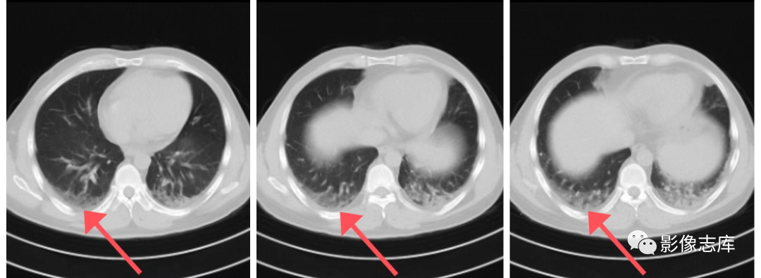 胸部CT扫描时如何识别肺坠<font color="red">积</font>性效应？