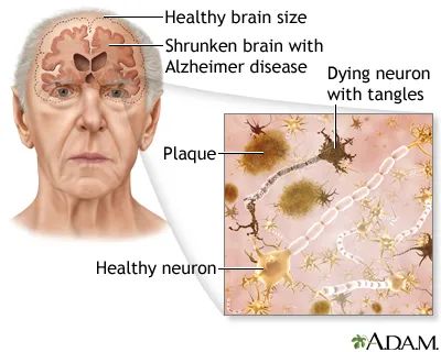 顶刊连发：炎症因子可预防阿尔茨海默病！