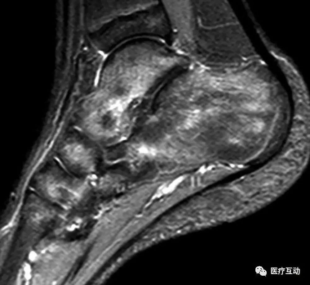 踝关节和后足骨髓<font color="red">水肿</font>的MRI特点