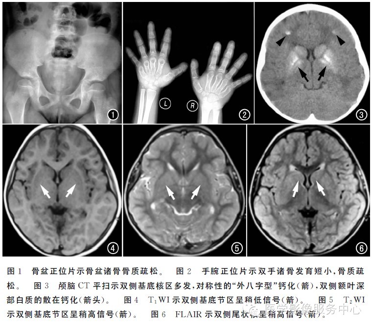 【疑难病例赏析】假性甲状旁腺<font color="red">功能减退</font>