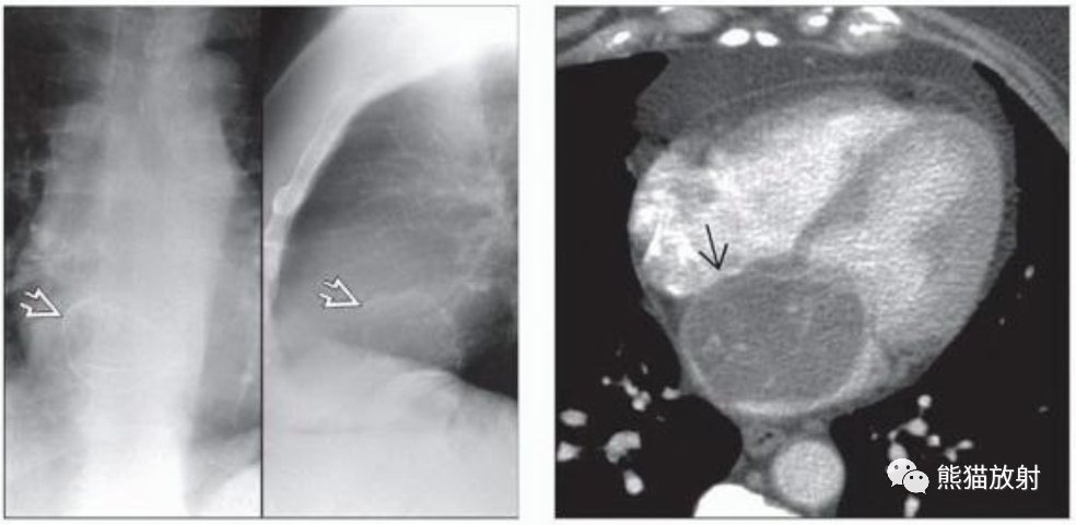 心脏粘液瘤、心脏肉瘤丨影像表现