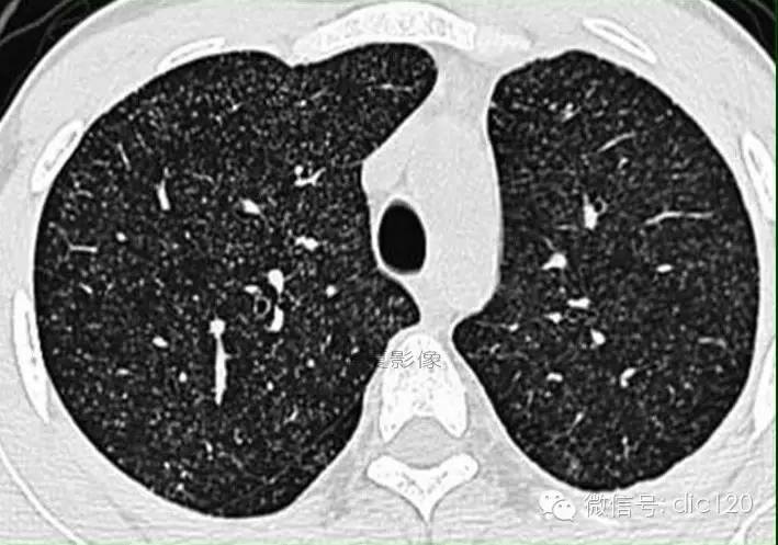 肺结核结节性病灶不同传播方式的HRCT表现
