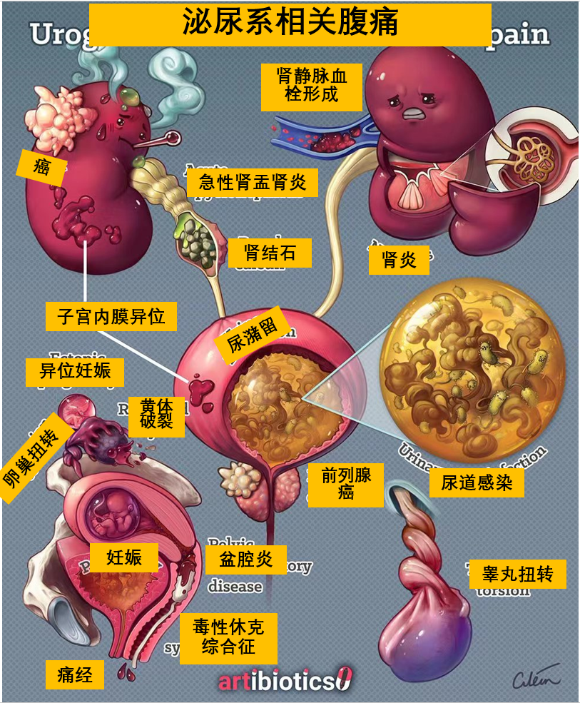 泌尿<font color="red">生殖系统</font>导致的腹痛