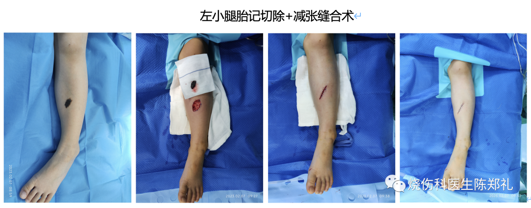 病例 | 左小腿胎记切除+减张缝合术
