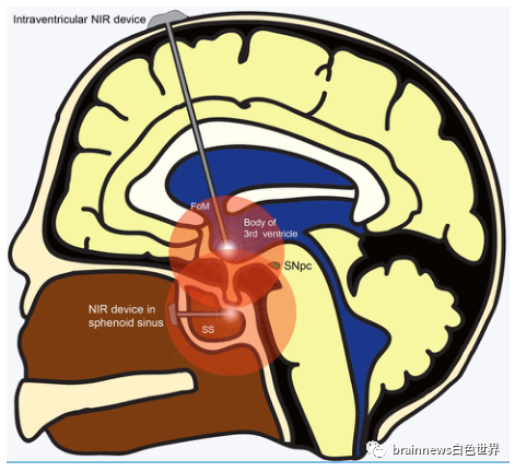 帕金森病创新疗法：脑部近红外<font color="red">光</font>靶向激活线粒体功能