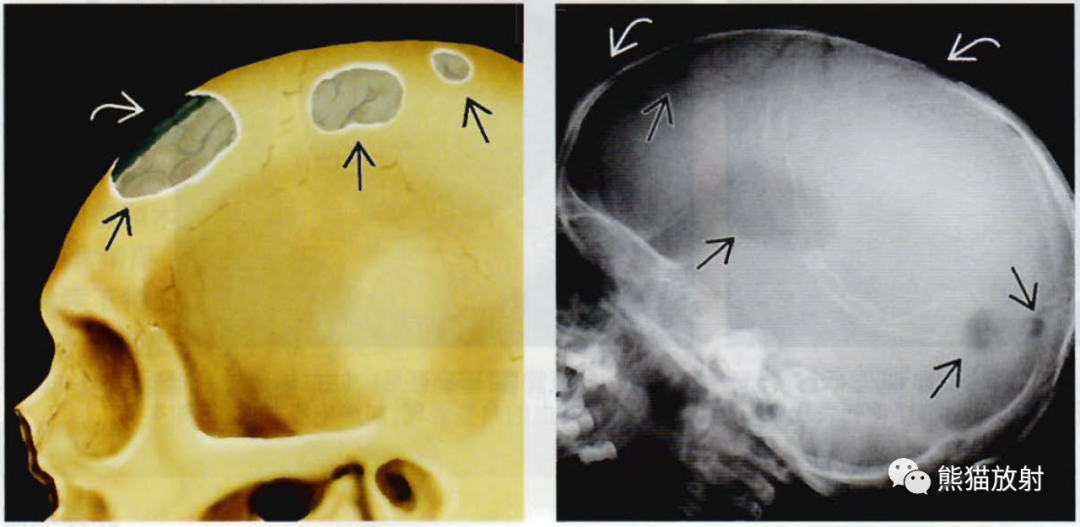 朗格汉斯细胞组织细胞增多症（颅骨和脑部）丨影像诊断相关要点