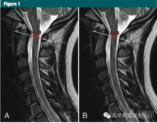 【Radiology】MR颈椎规范测量评估椎管狭窄