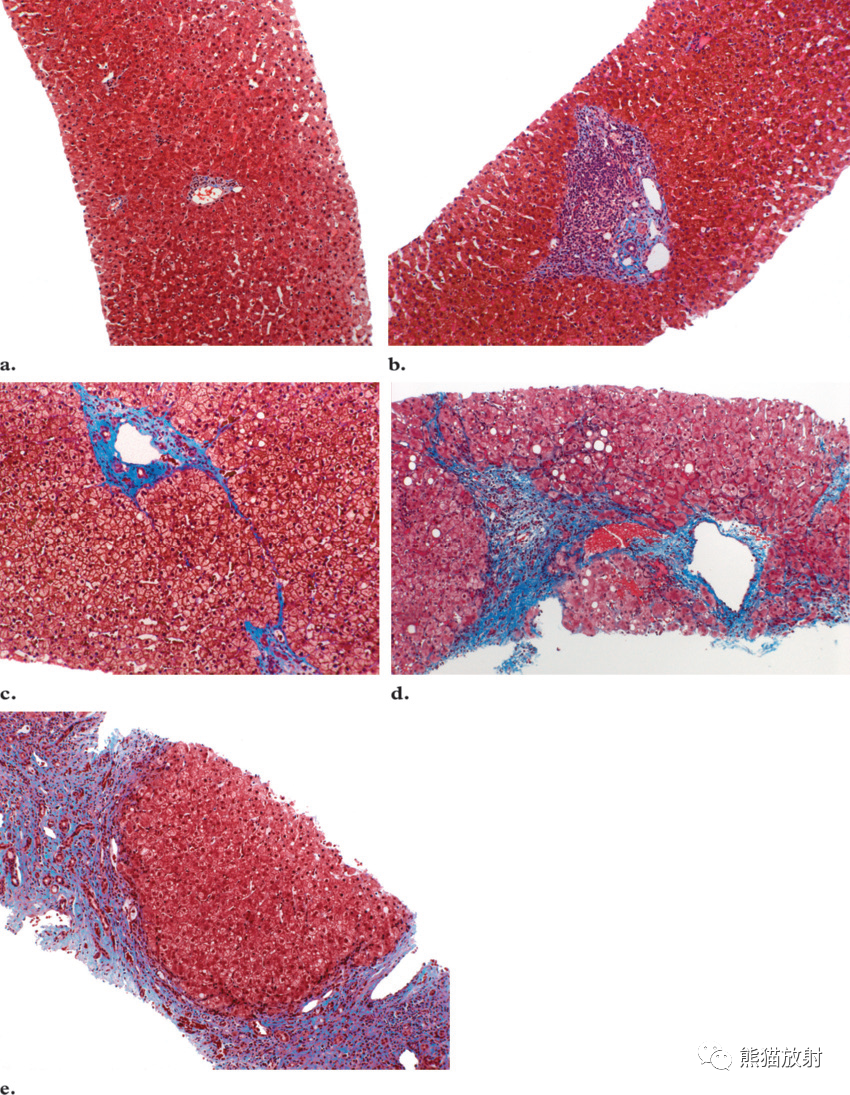 肝纤维化丨MR成像方法及表现