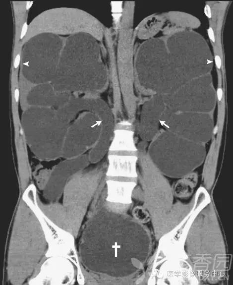 【NEJM】非<font color="red">梗阻性</font>肾积水导致的真性红细胞增多