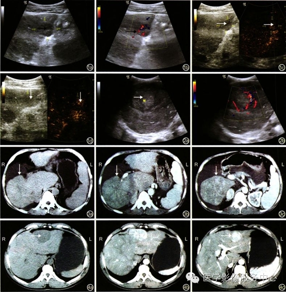 布-加综合征合并肝脏结节的影像学诊断