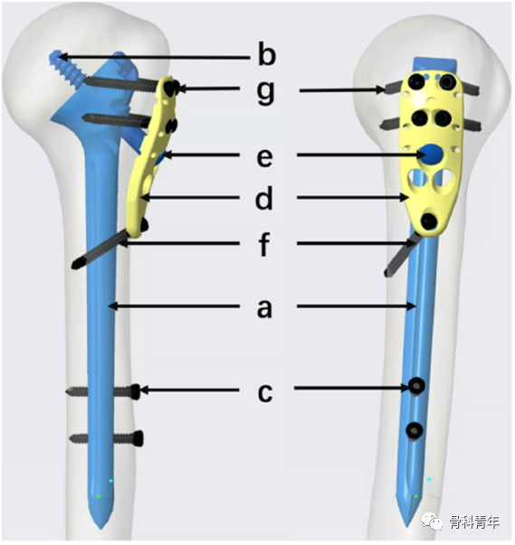 手术技术｜髓内支撑钉-板系统治疗复杂肱骨近端骨折