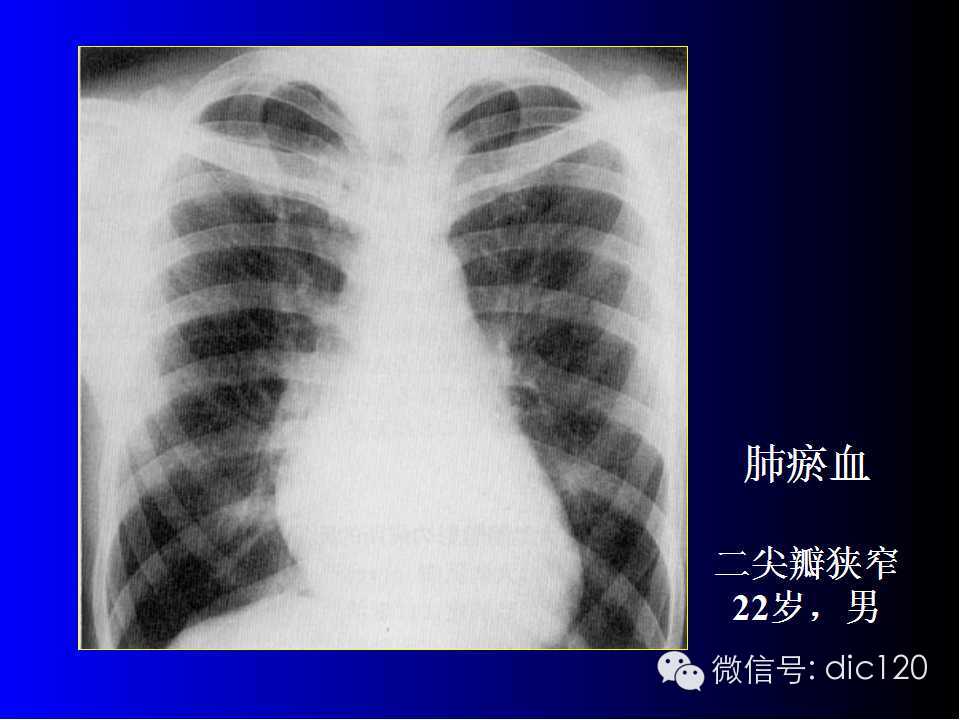 X线鉴别肺淤血、肺水肿、肺梗死