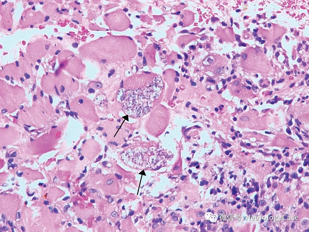 Neurology病例：罕见发生的累及咀嚼<font color="red">肌</font>的微孢子虫<font color="red">肌</font><font color="red">炎</font>