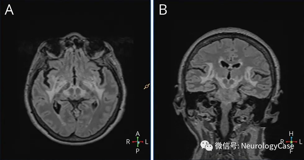 Neurology病例：莱姆神经疏<font color="red">螺旋体</font><font color="red">病</font>的非典型表现：可逆的锥体外系综合征和认知损害