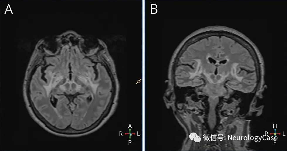 Neurology病例：莱姆神经疏螺旋体病的非典型表现：可逆的<font color="red">锥体</font>外系综合征和认知损害
