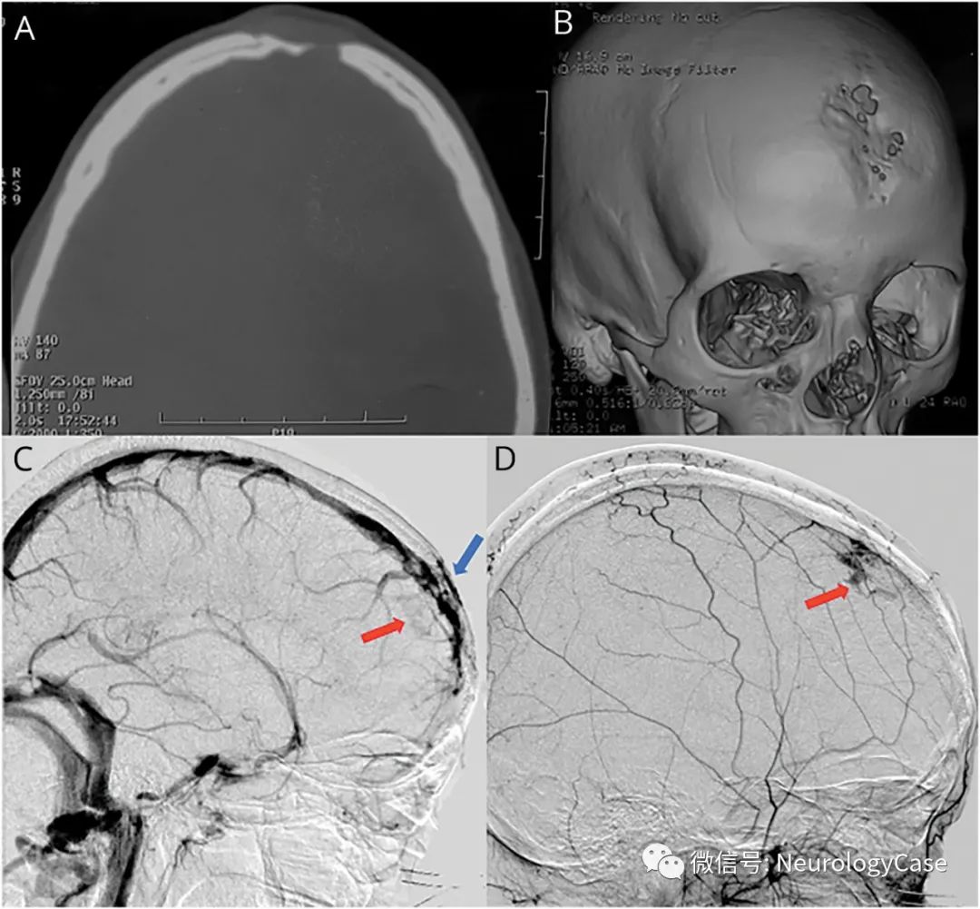 Neurology病例：见于搏动性额部肿块女性的颅骨骨膜窦伴硬脑膜静脉湖