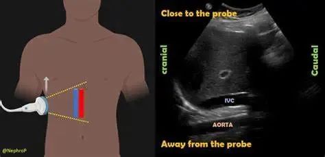如何经肝脏测量下腔静脉图示