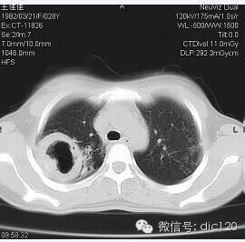 肺内单发空洞的影像--诊断--鉴别--总结