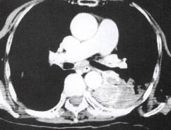 肺部病变的“CT血管影征(血管包埋征肺静脉包被征)”