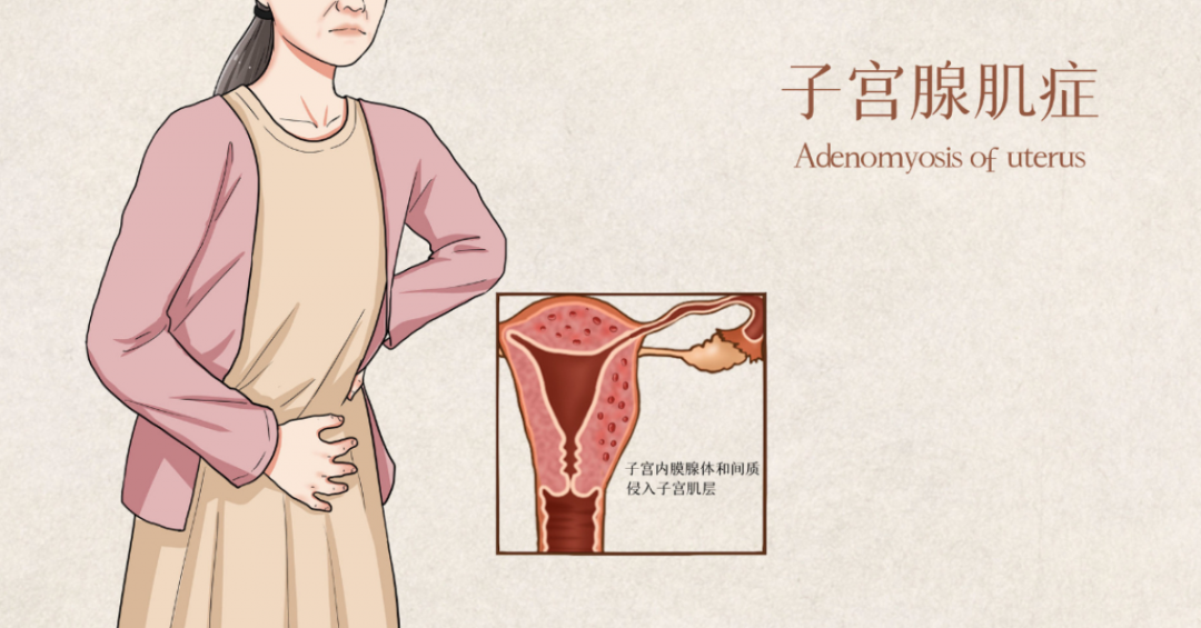 月经过多、每月“痛不欲生”、不孕？可能患上子宫腺肌病