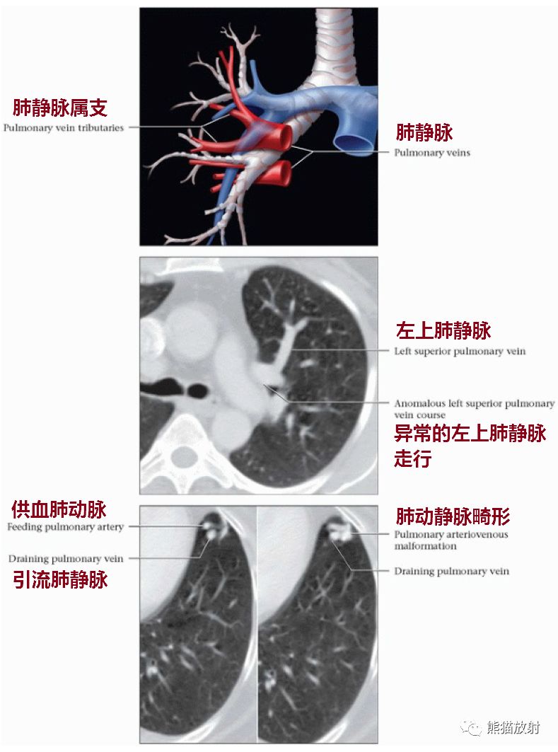 <font color="red">肺静脉</font>——解剖、正常及部分异常影像，归纳！