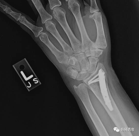 介绍4种桡骨远端骨折的新型内固定技术@MedSci