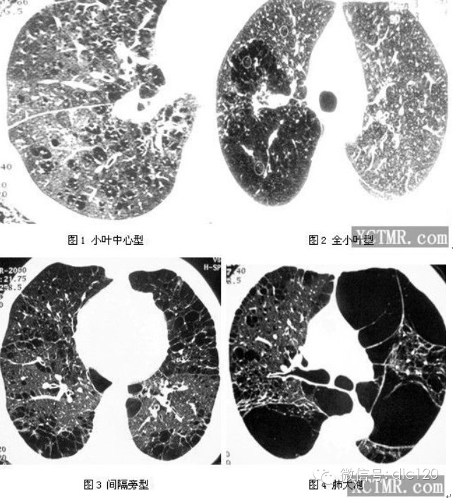 肺弥漫性病变的CT影像分析