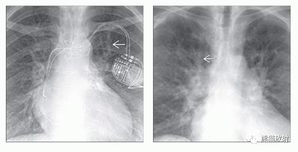 心源性/非心源性肺水肿丨影像表现