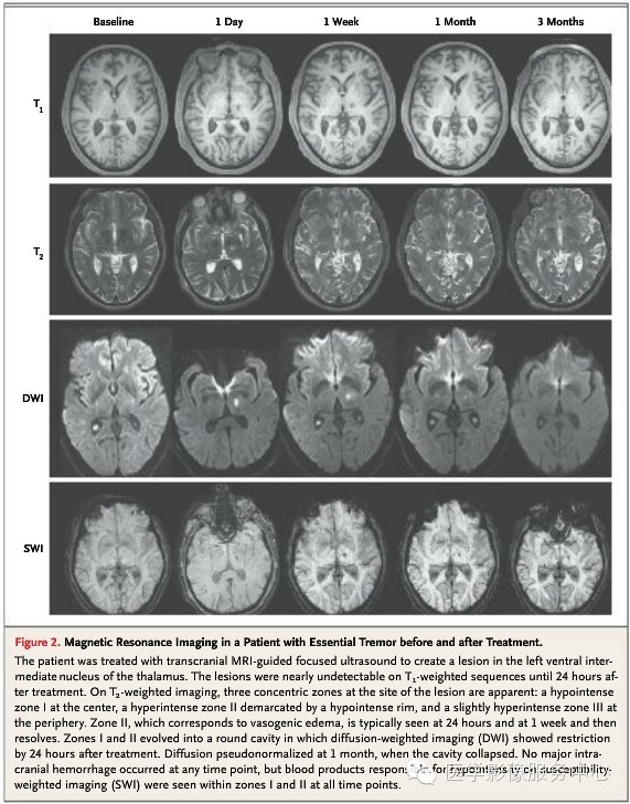 【NEJM】MRI引导下丘脑损毁术治疗特发性震颤安全有效