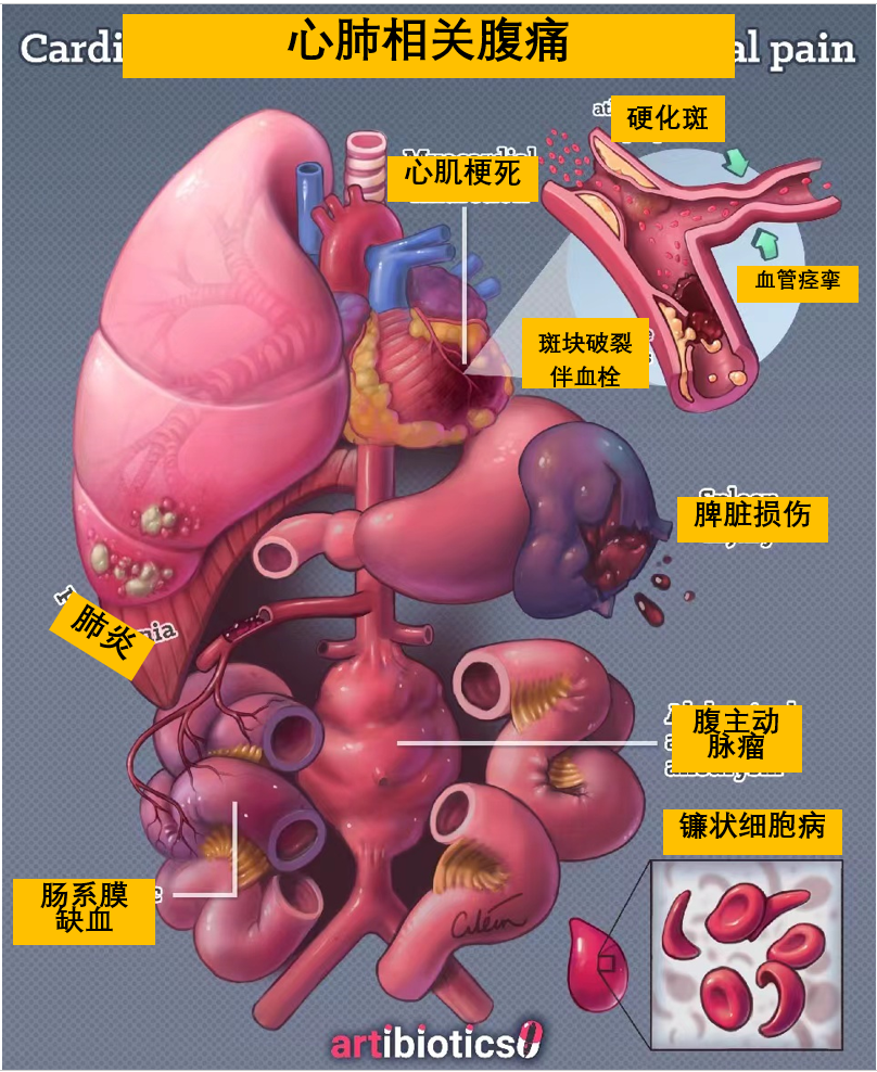 一<font color="red">图</font>了解：心肺原因导致的腹痛