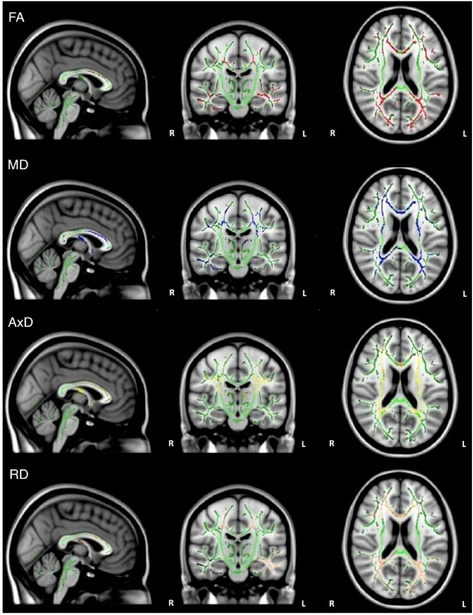 Front Aging Neurosci新视角——从脑白质角度追踪阿尔茨海默病发展