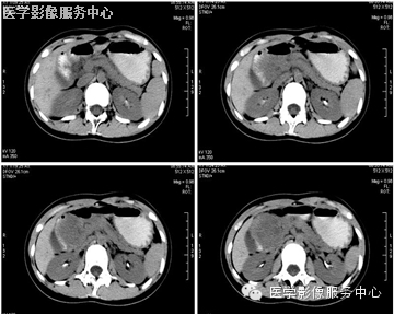 腹腔<font color="red">病变</font>