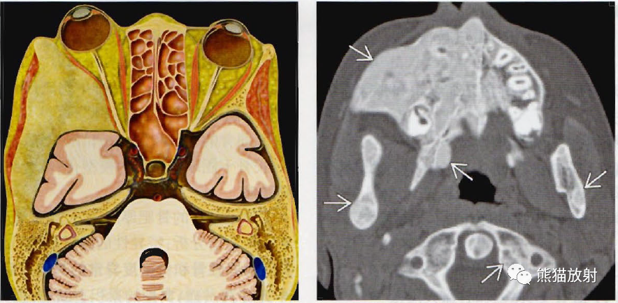 颅骨纤维结构不良、Paget病丨影像诊断相关要点