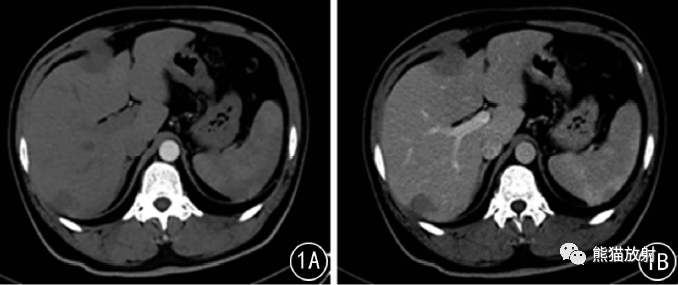 肝炎性肌纤维母细胞瘤丨MRI及<font color="red">CT</font>表现