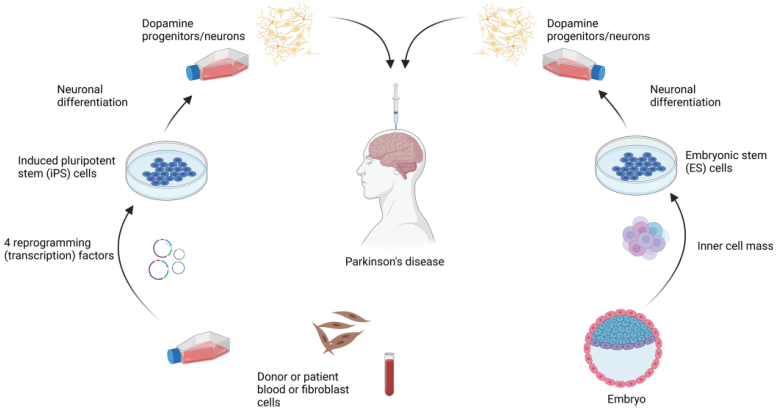 MovementDisorders：干细胞衍生的多巴胺神经元移植疗法治疗帕金森病的研究进展