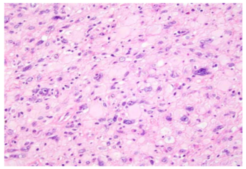 浅表 CD34 阳性纤维母细胞性肿瘤的临床病理特点