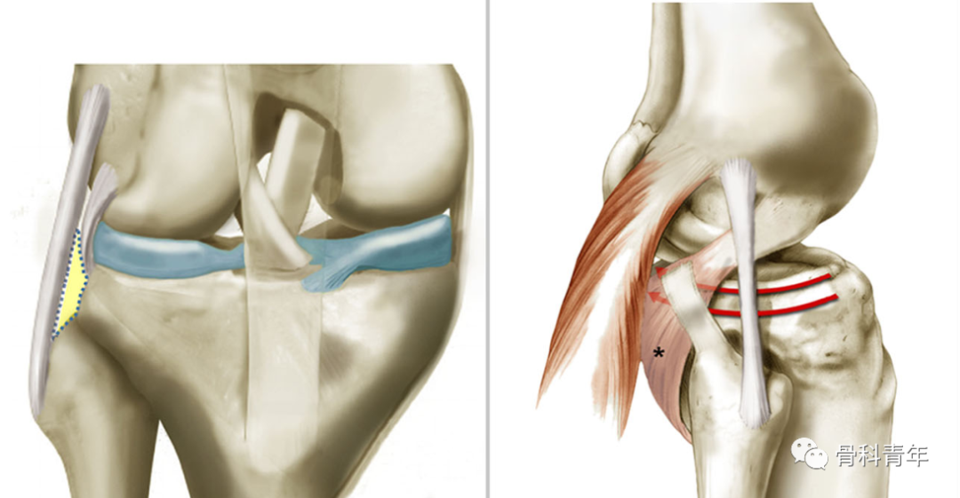 手术技术｜胫骨平台后侧双髁冠状面劈裂骨折的新型内固定方法